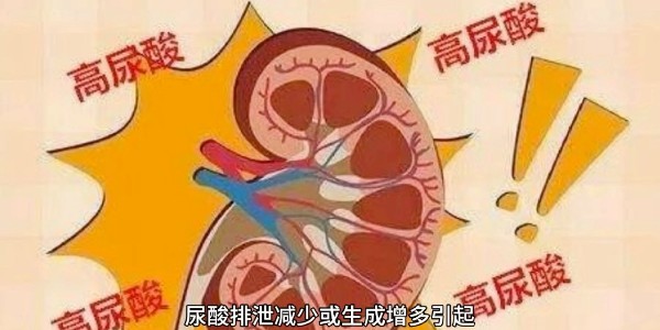 突然痛風？別再只怪啤酒和燒烤！真正的“尿酸元兇”遠比你想的多！